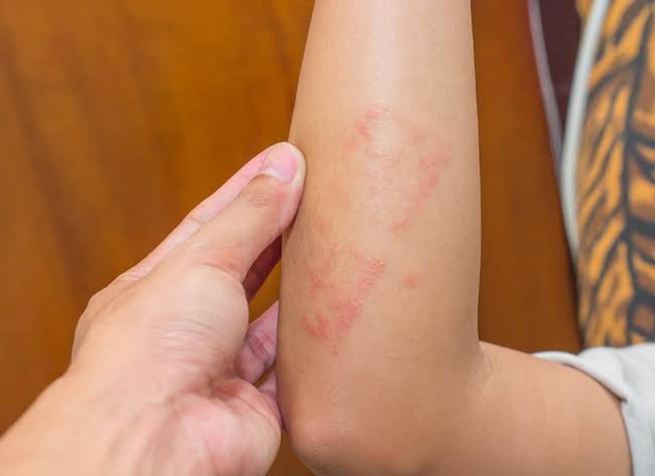 6 Jenis Infeksi Jamur yang Ngga Boleh Dianggap Sepele